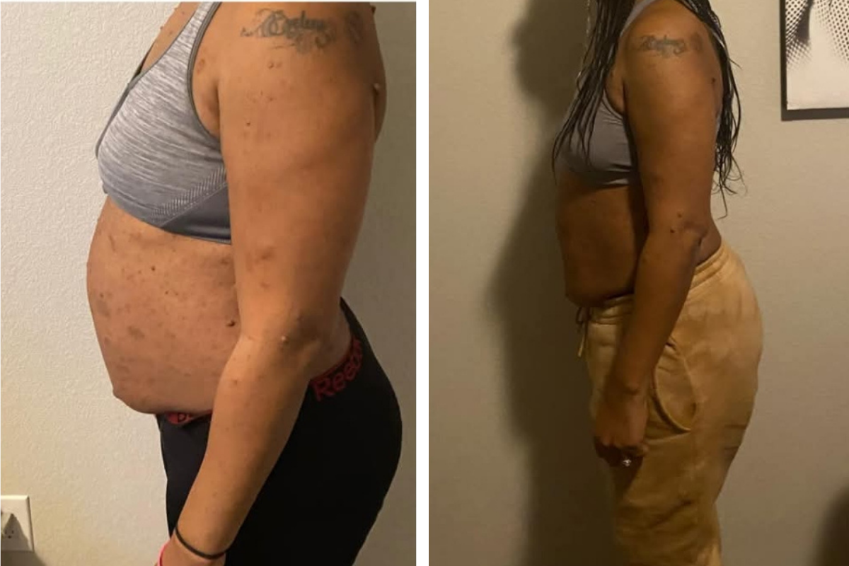 non invasive fat removal .png