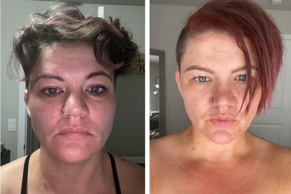 chemical peel (1).png