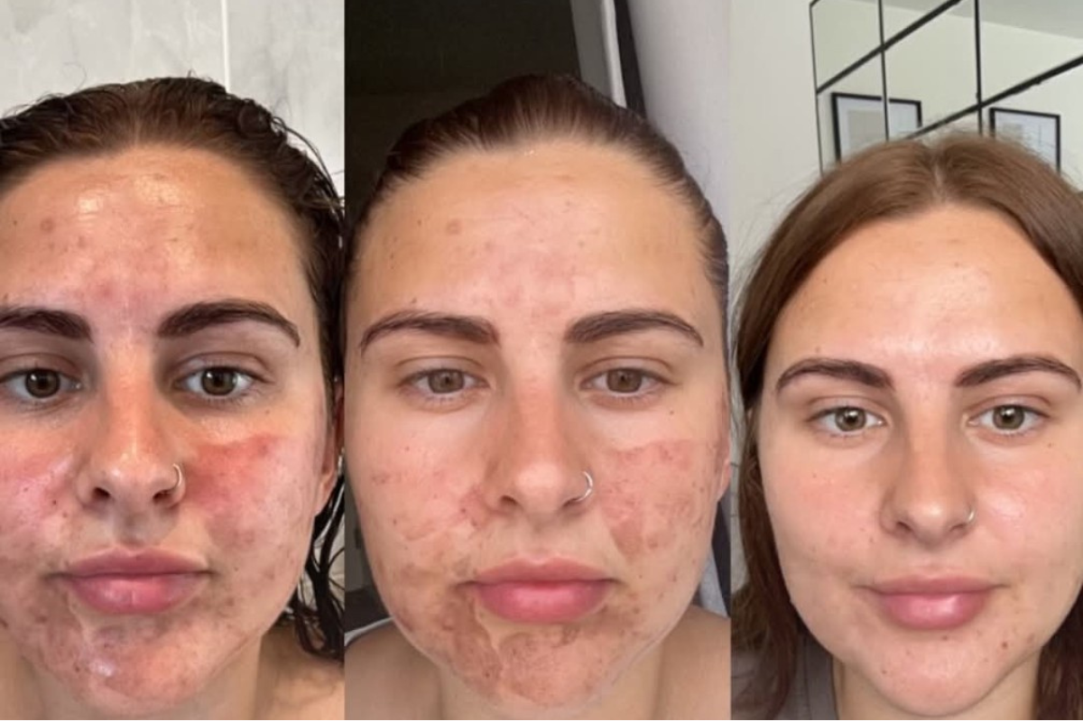 chemical peel .png