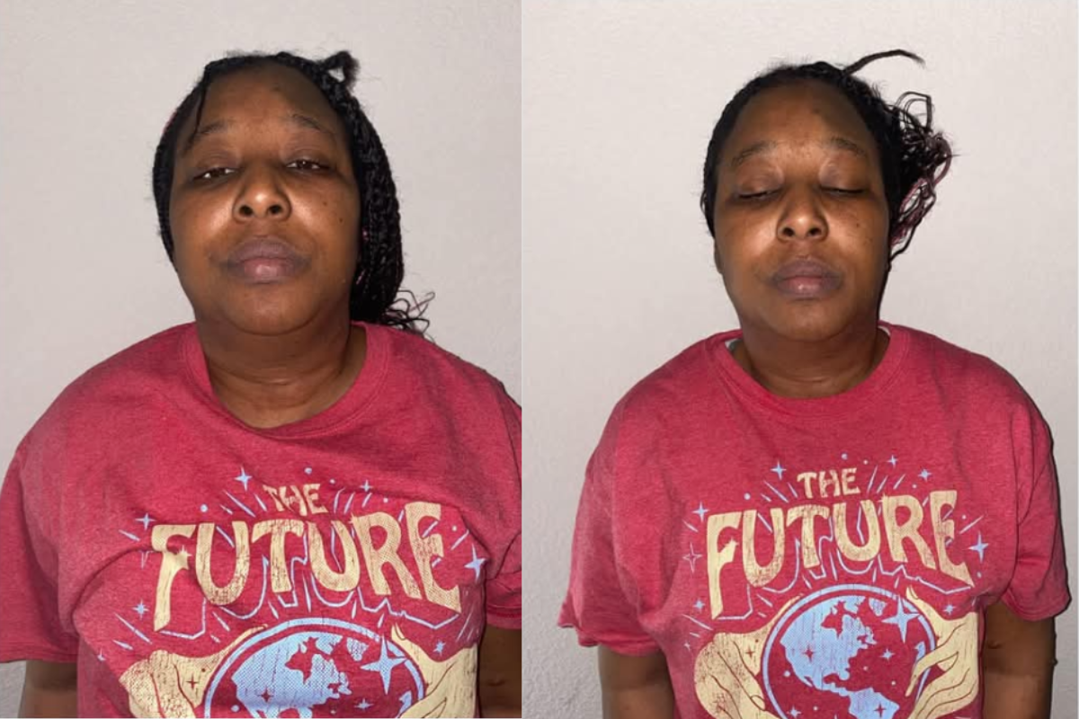 microneedling (15).png