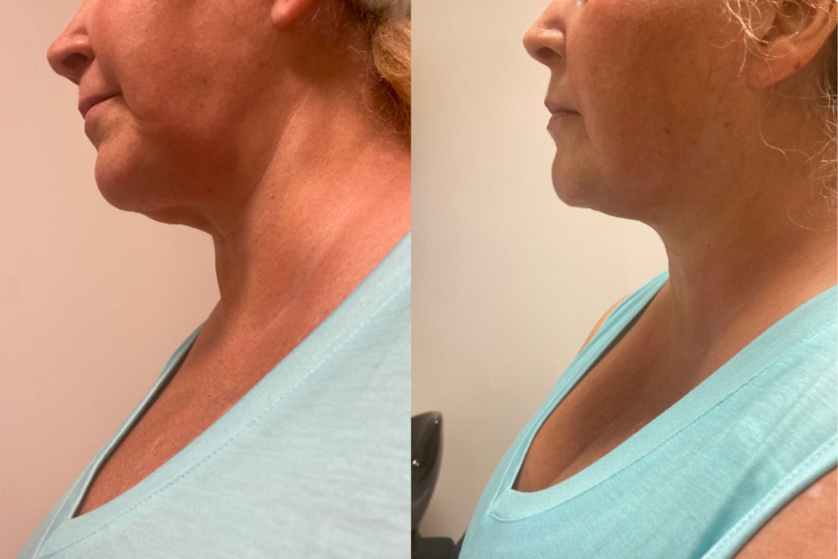 microneedling (20).png