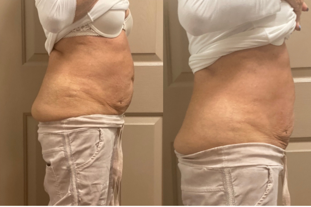 microneedling (19).png