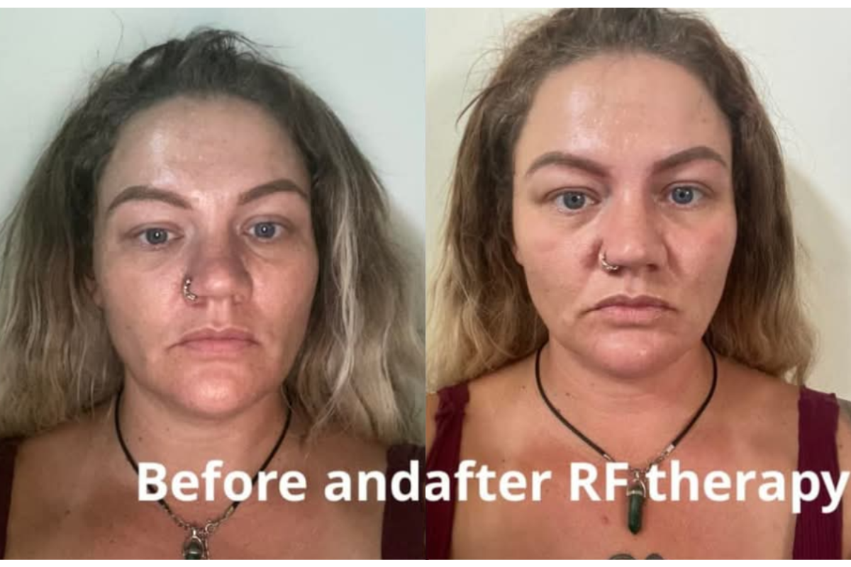 microneedling (14).png