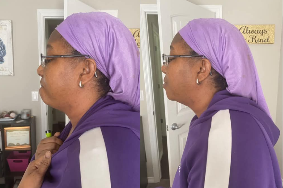 microneedling (12).png
