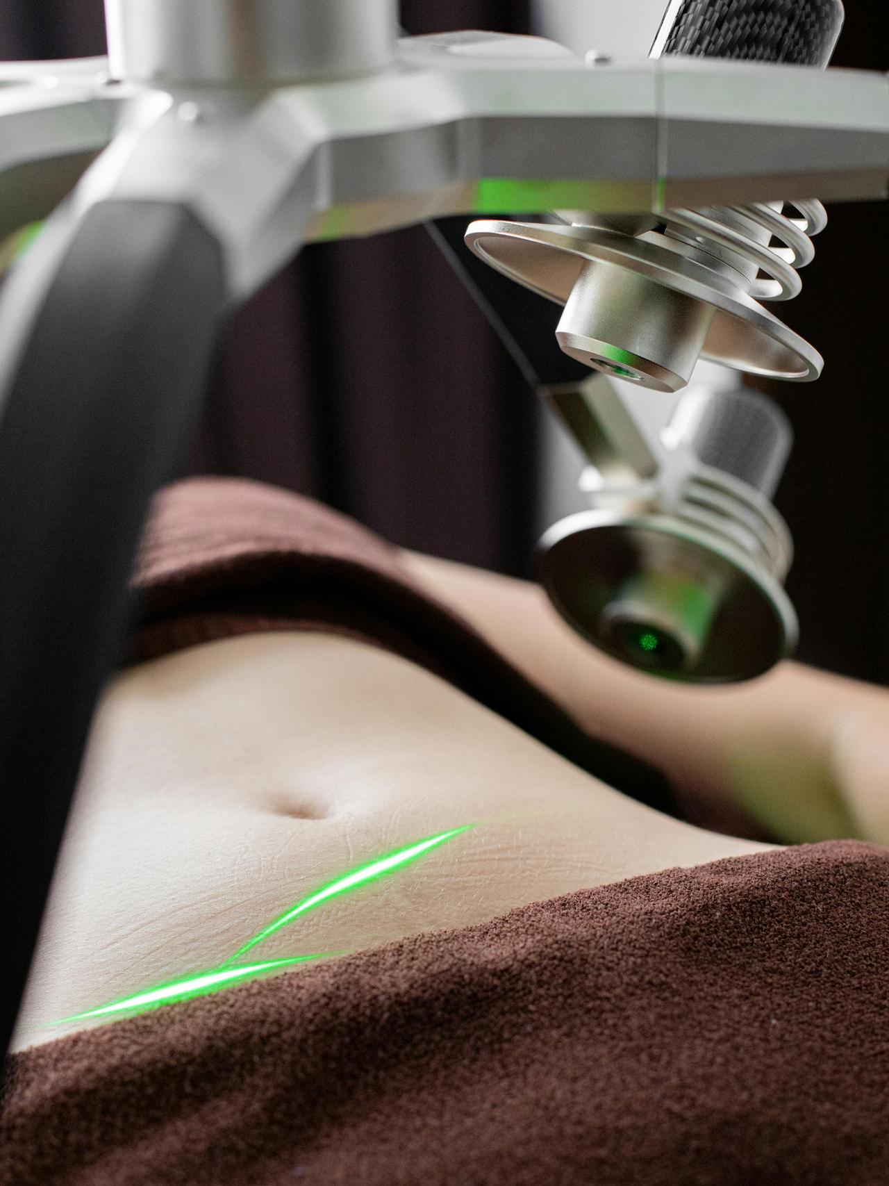 Close-up of a laser device used in non-invasive body contouring treatment on a woman's abdomen.