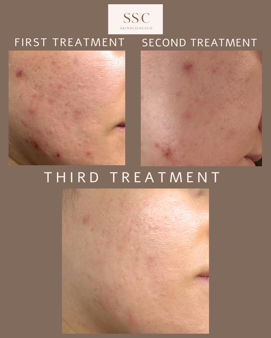 Treatment results showing skin transformation