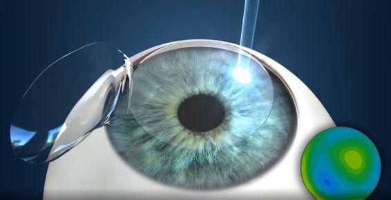 lasik-wavefront-2.jpg