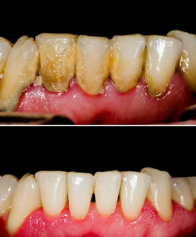 Before and after scaling and root planing gum therapy treatment showing improved gum health