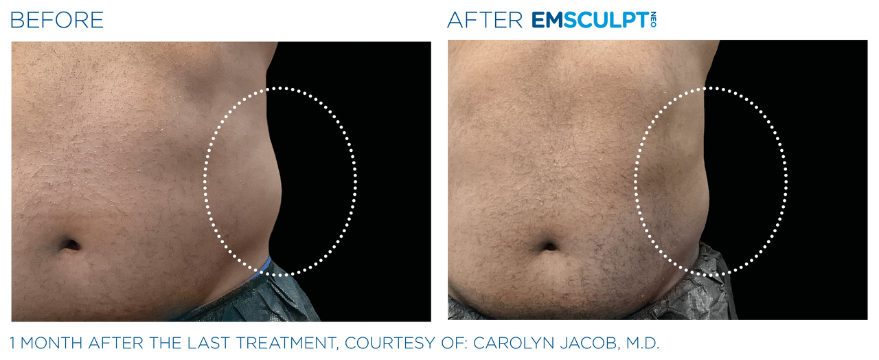 emsculpt_neo_pic_ba-card-female-lateral-abdomen-158_enus100.png
