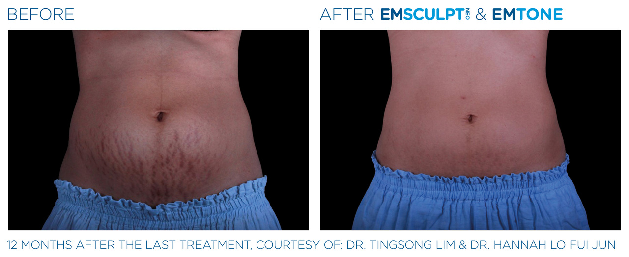 emsculpt_neo-emtone_pic_ba-card-female-abdomen-015_enus100.png