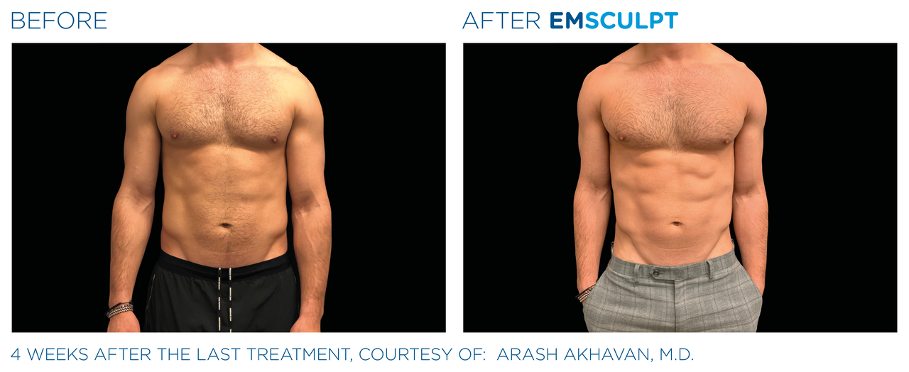 emsculpt_pic_ba-card-male-abdomen-108_for-neo_enus100.png