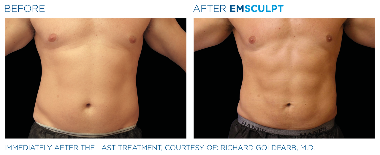 emsculpt_pic_ba-card-male-abdomen-116_for-neo_enus100.png