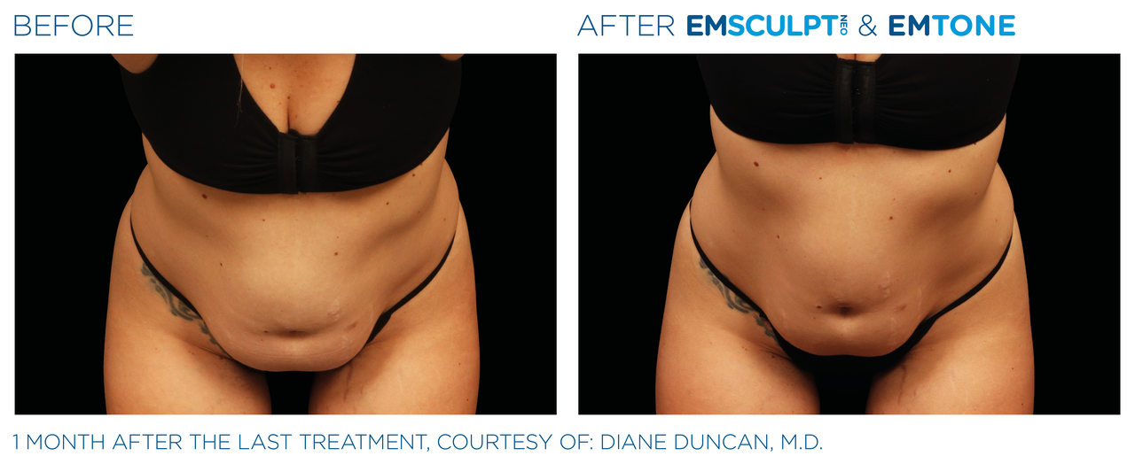 emsculpt_neo-emtone_pic_ba-card-female-abdomen-003_enus100.png