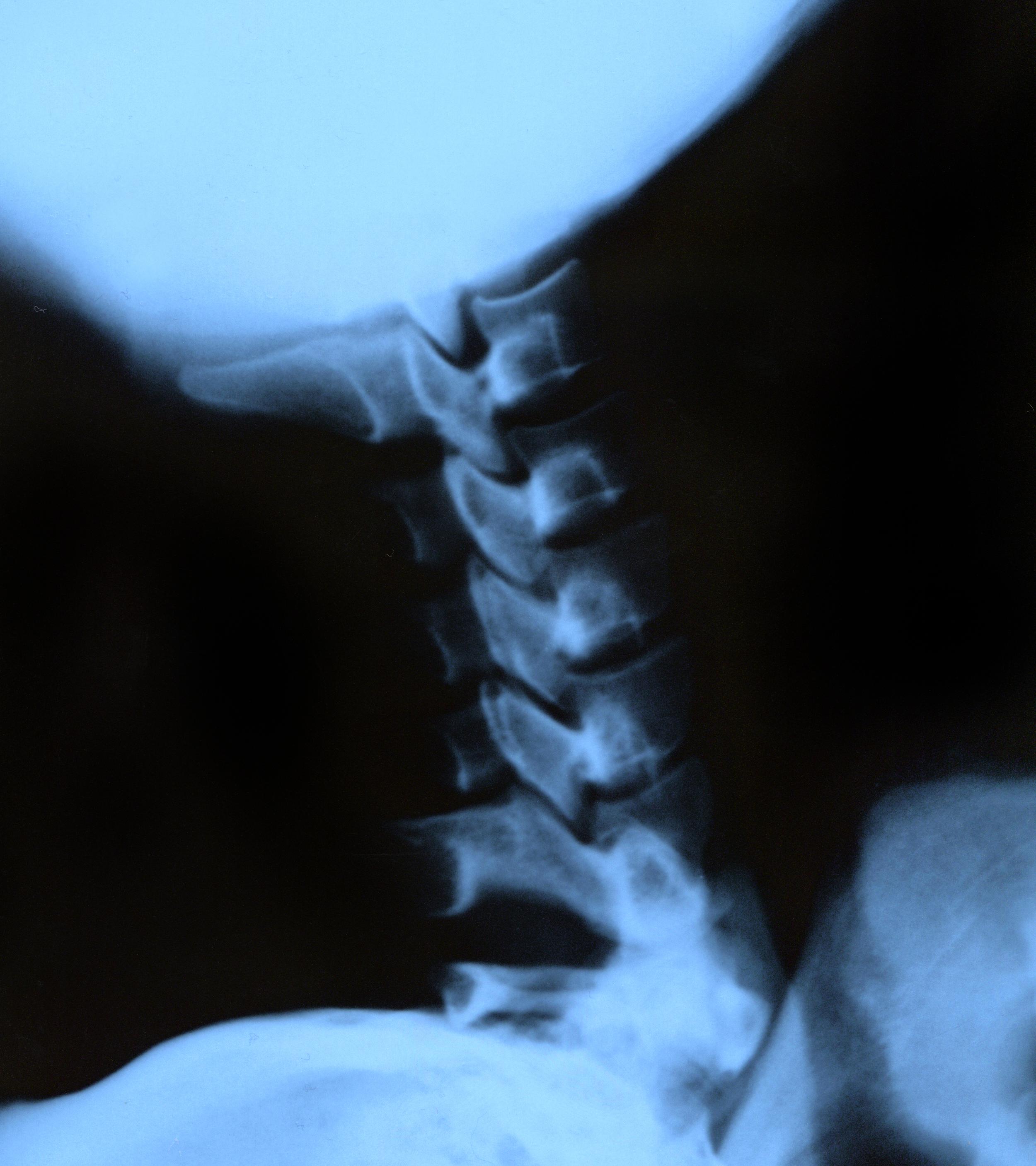 x-ray-of-spine-demonstrating-medical-imaging-2026-03-24-08-52-38-utc.jpg