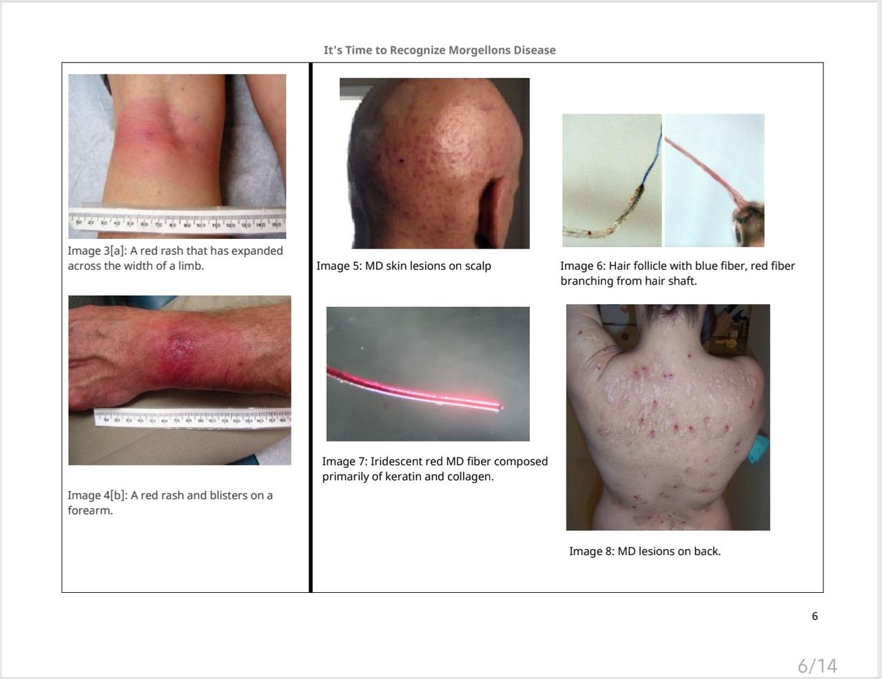 phac morgellons lyme website update06.jpg