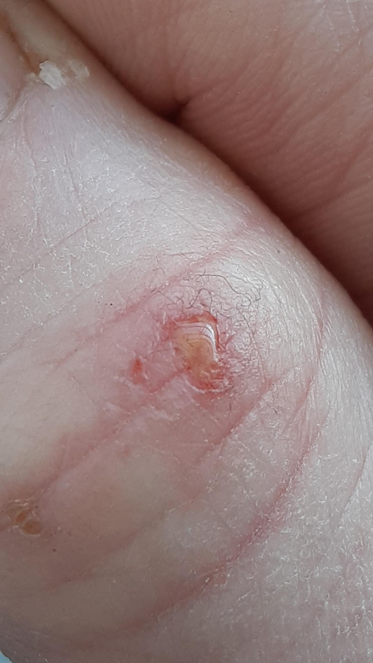 09b - morgellons photo lance.jpg