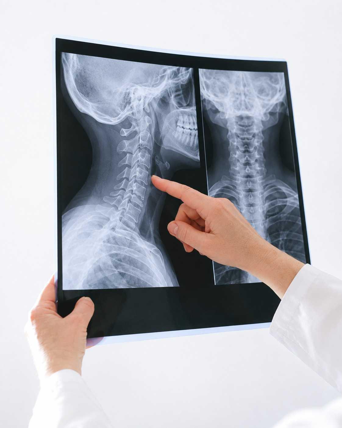 Doctor reviewing spinal X-ray for posture and spinal alignment