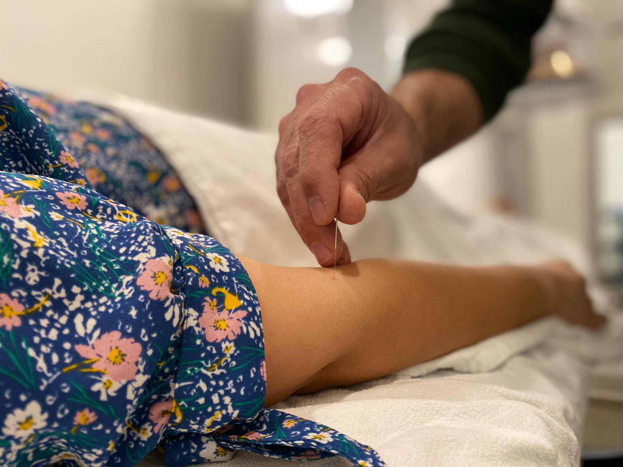 Registered acupuncturist using sterile needles in a treatment session.