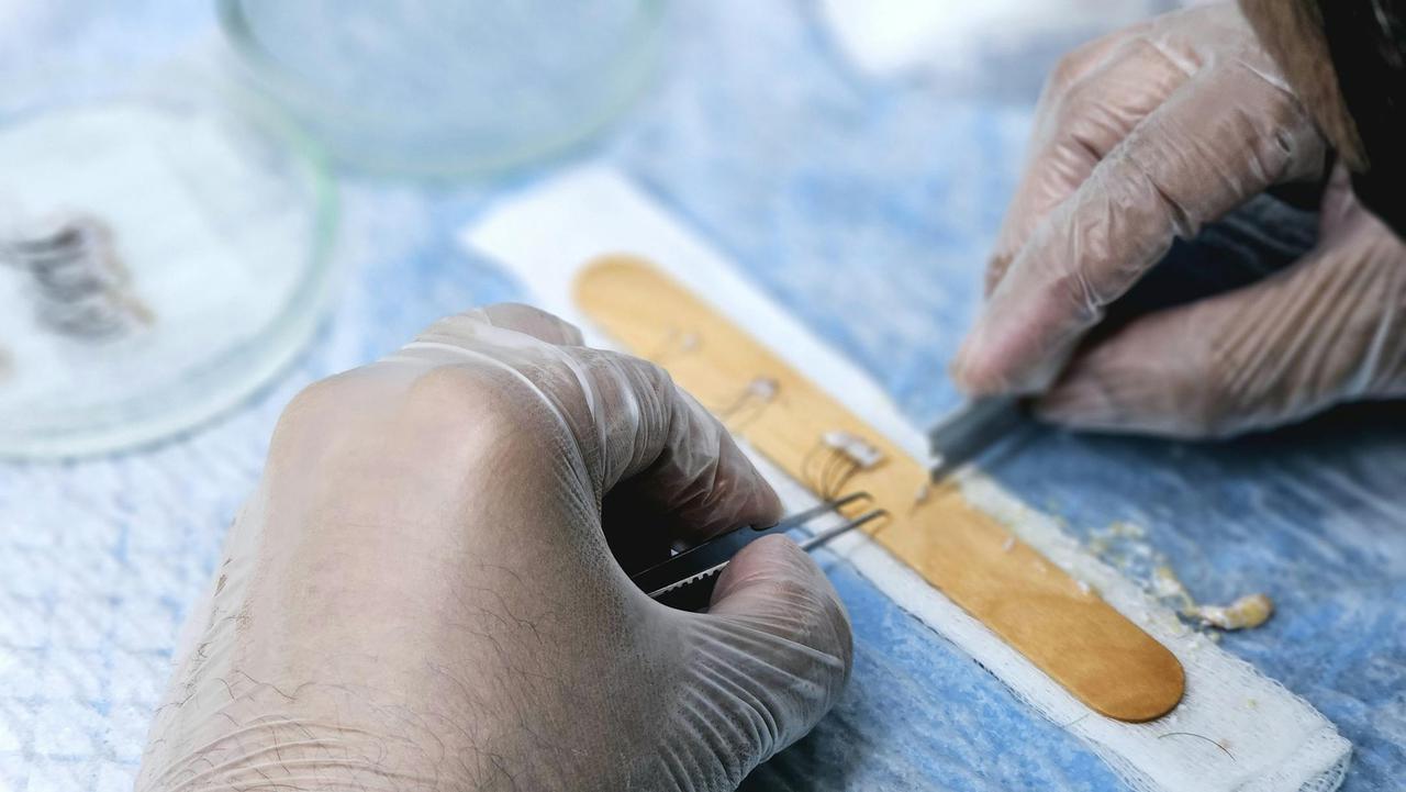 Close-up of surgeons preparing hair grafts for transplantation, demonstrating precise skills.