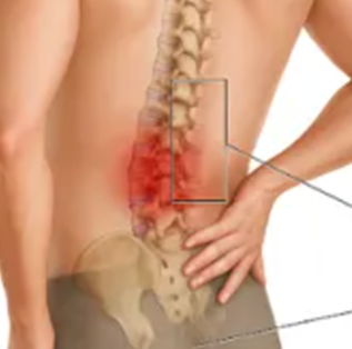 lumbar radiculopathy.png