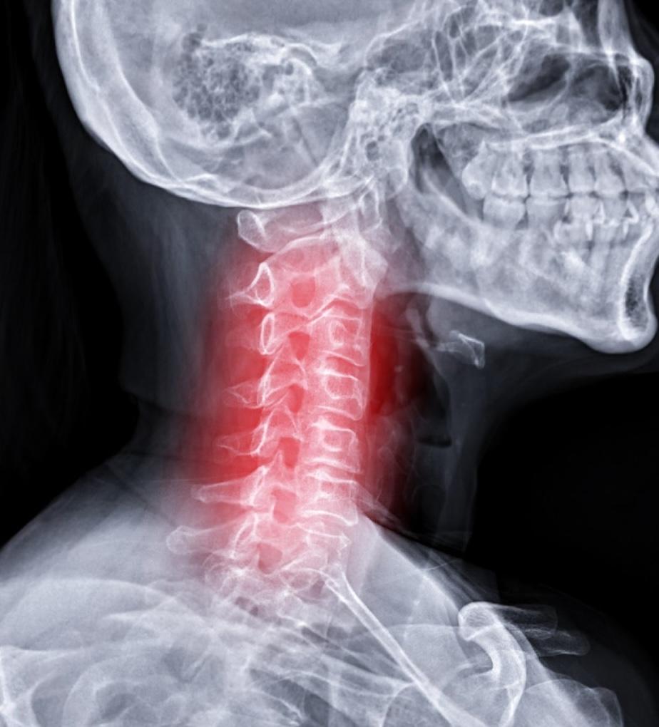 cervical disc herniation.jpeg