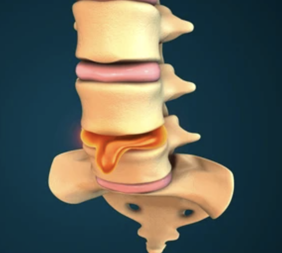 lumbar disc herniation.png
