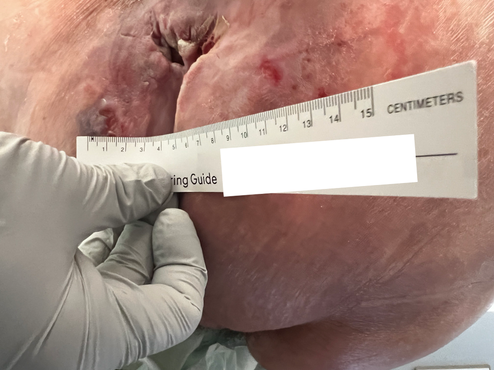 sacral pressure ulcer 1.png