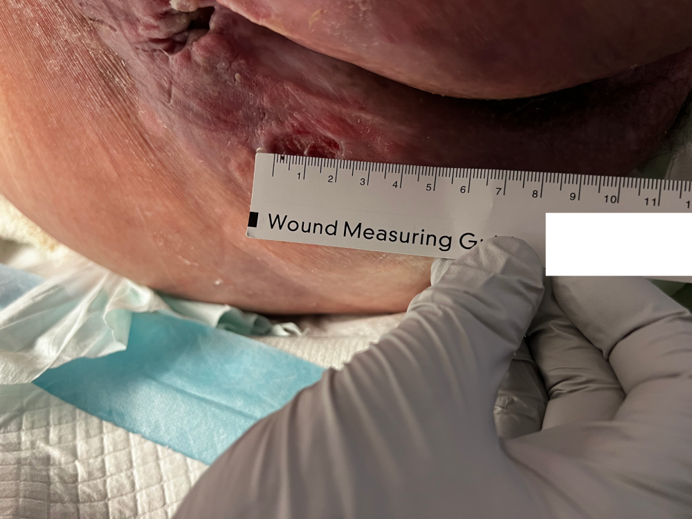 sacral pressure ulcer 2.png