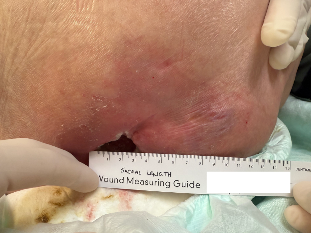 sacral pressure ulcer 3.png