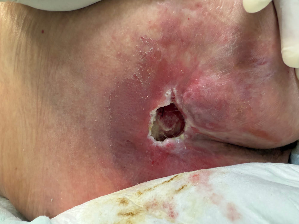 sacral pressure ulcer 4.png