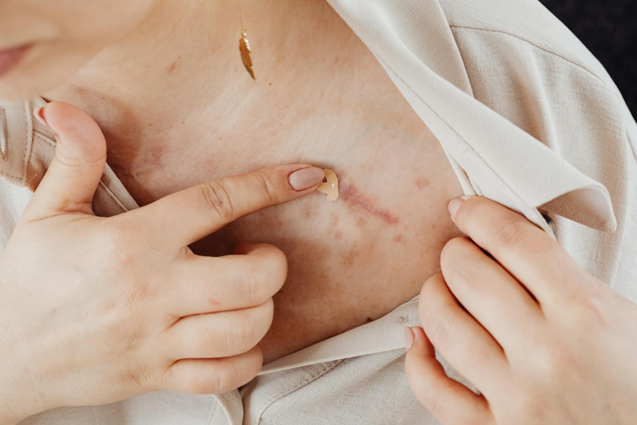 Close-up view of a woman applying cosmetic product to a scar on her chest.