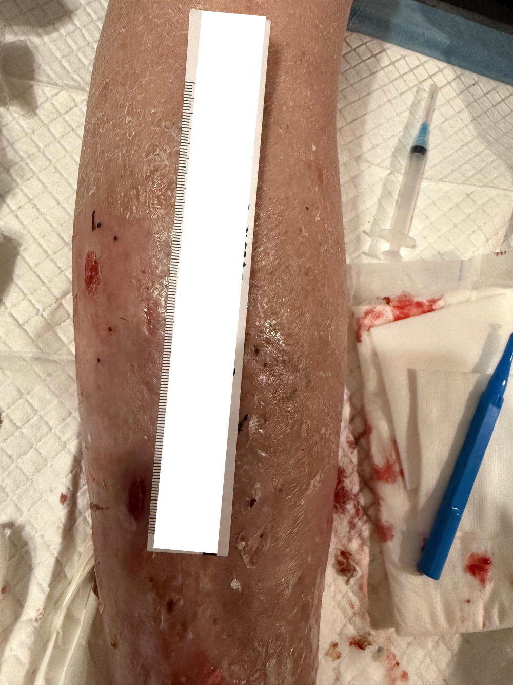 chronic wound 2 after.png