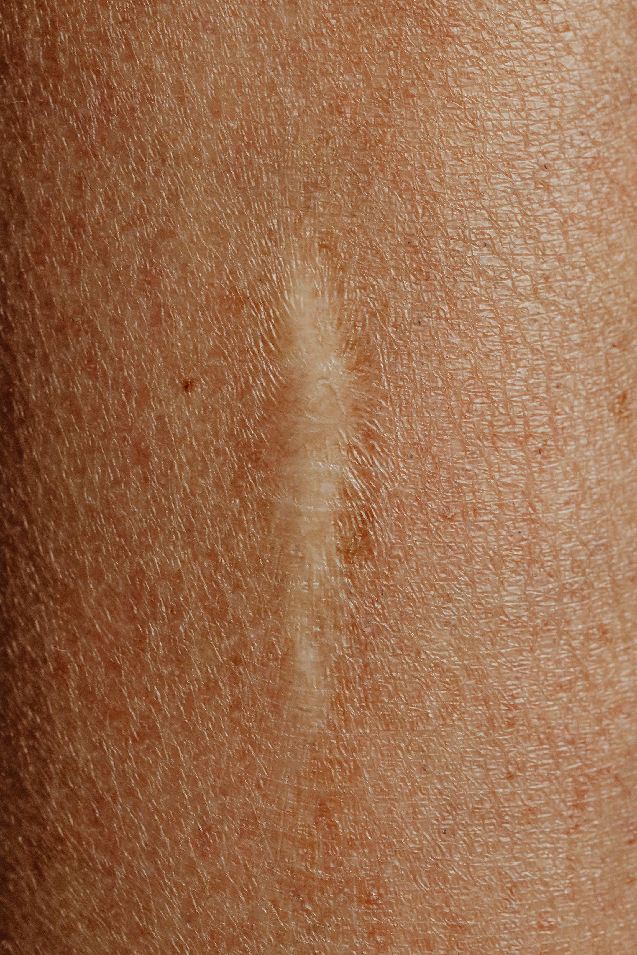 Detailed close-up image of a skin scar, highlighting texture and healing.