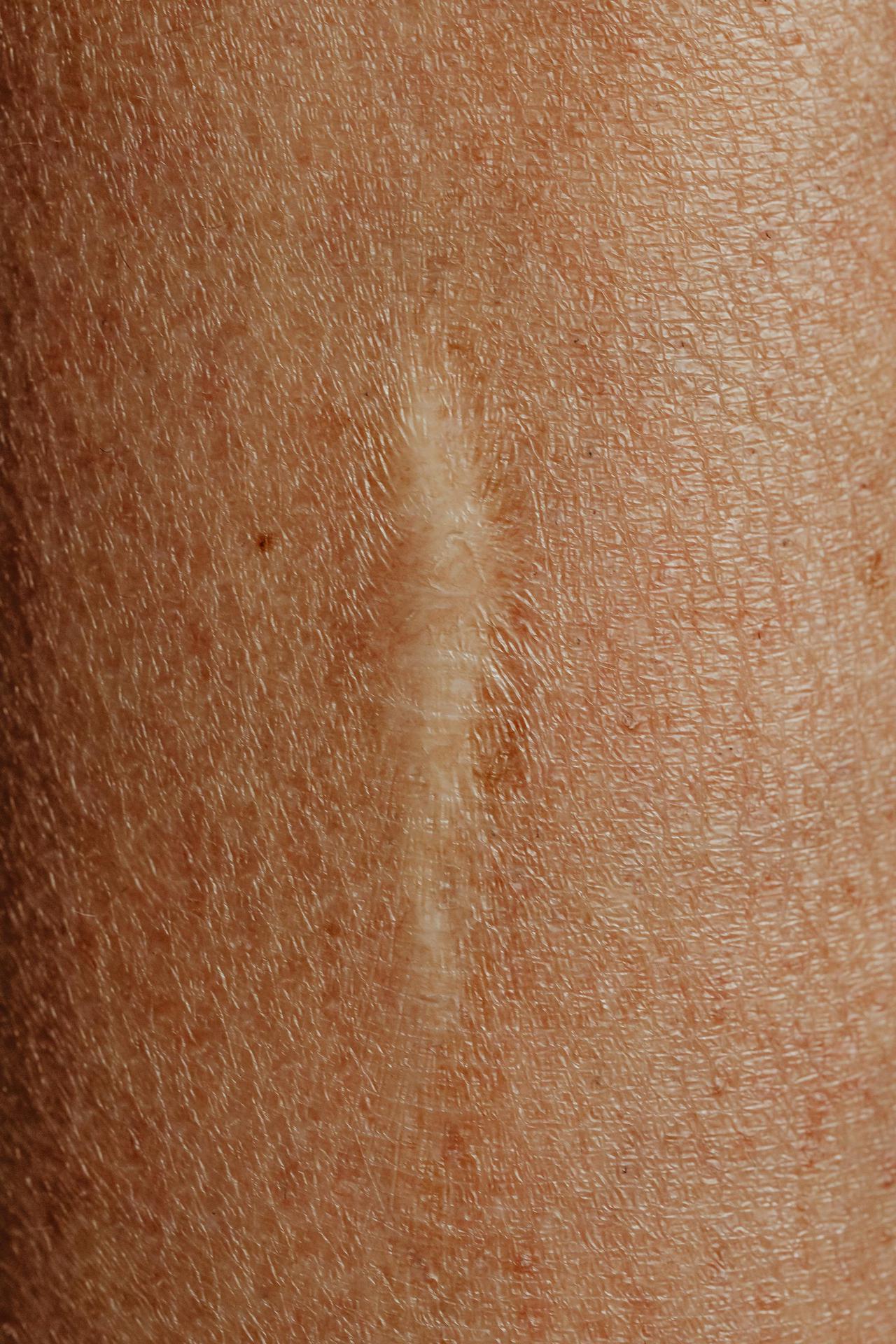 Detailed close-up image of a skin scar, highlighting texture and healing.
