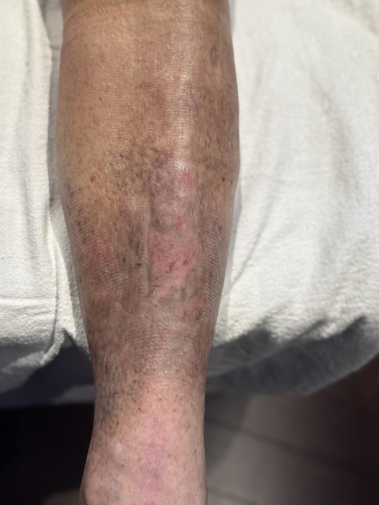 chronic wound 1 after.jpg