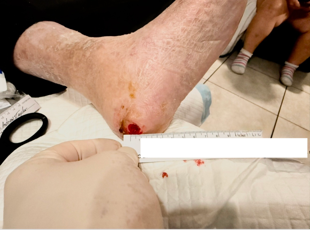 diabetic foot ulcer 1.png