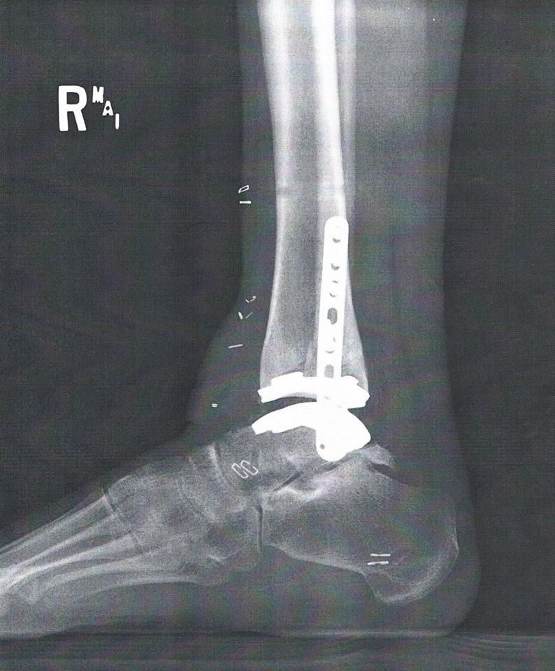 adrienne bulinski ankle replacement.jpg