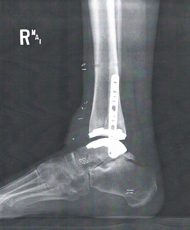 adrienne bulinski ankle replacement.jpg