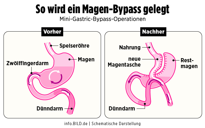 Magen-Bypass-Reversal-Illustration