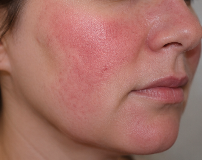 Rosacea