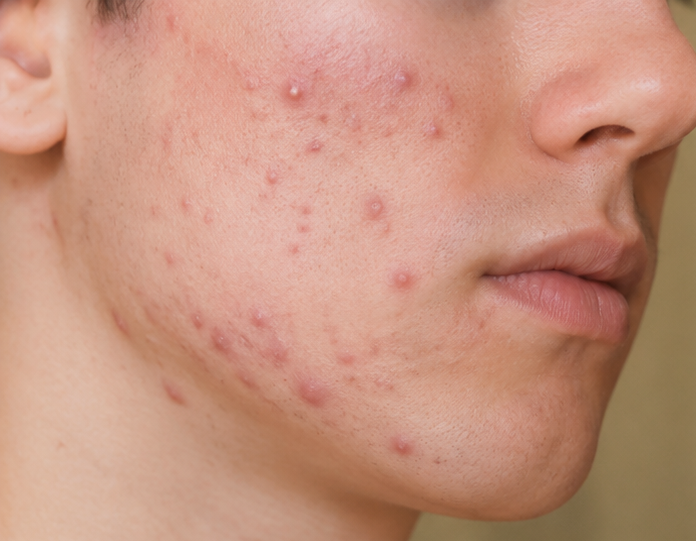 Acne