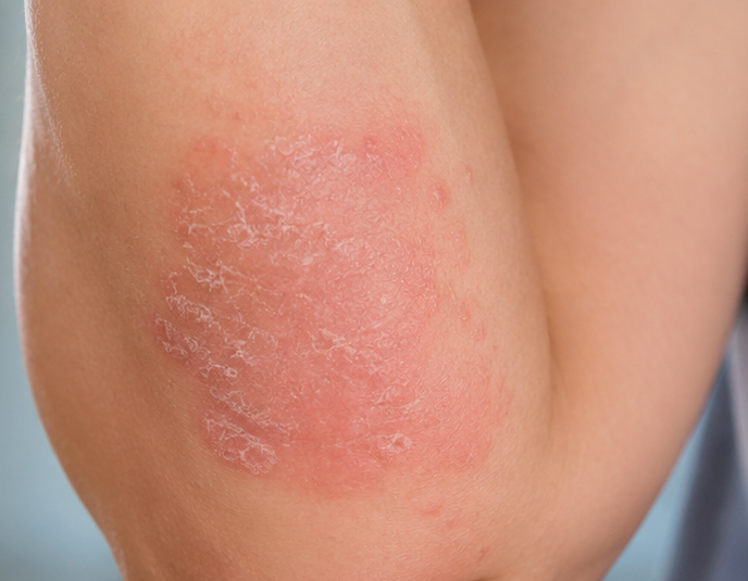 Eczema