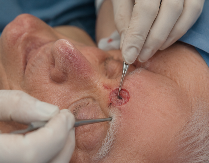 Skin Cancer