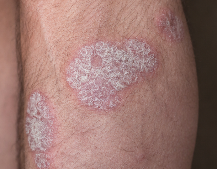 Psoriasis