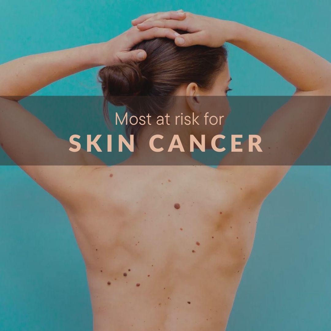 skin cancer (1).jpg