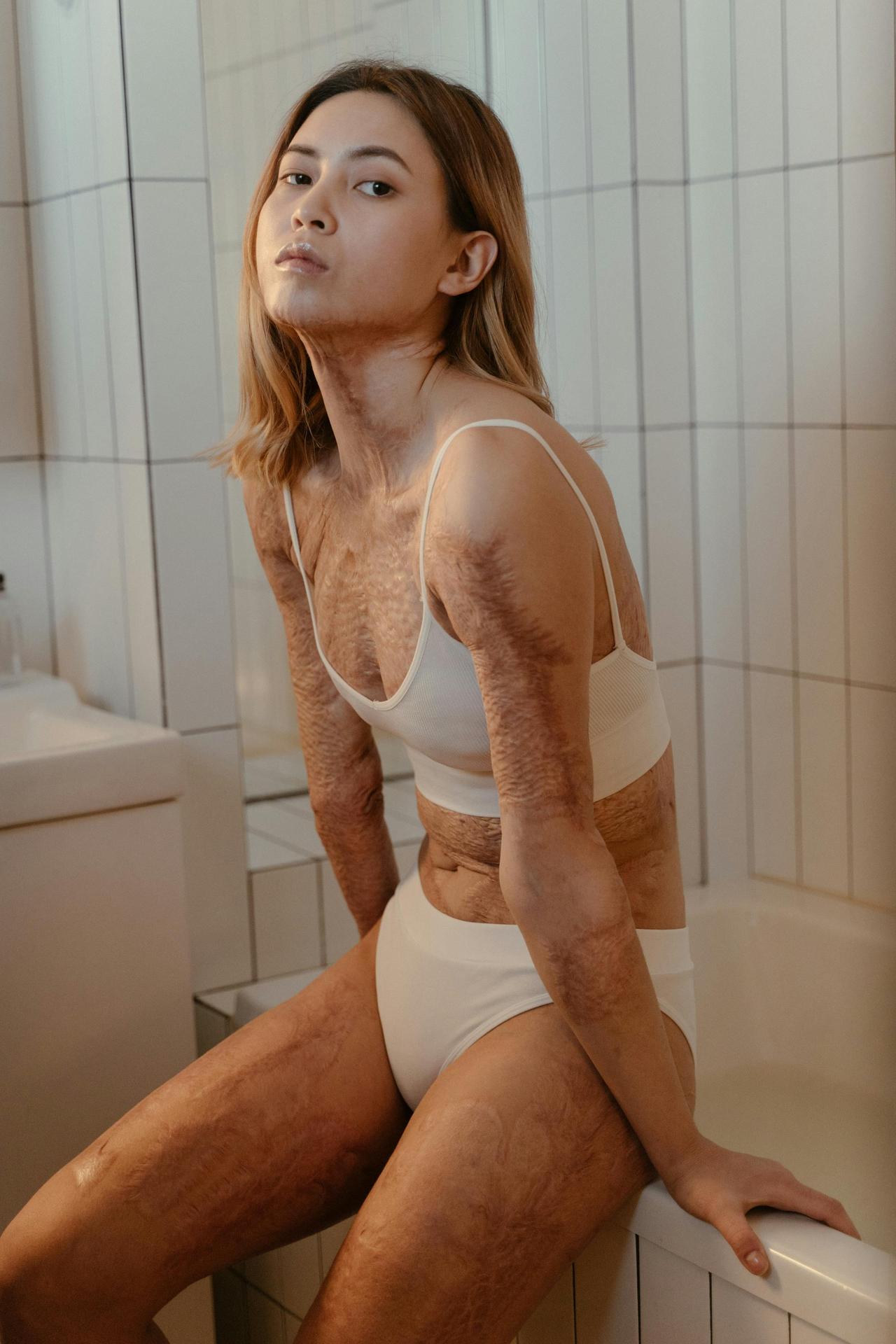 A confident woman in a bathroom, showcasing beauty and resilience despite burn scars.